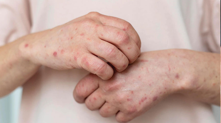 Sedef Hastalığı Bulaşıcı Mıdır?